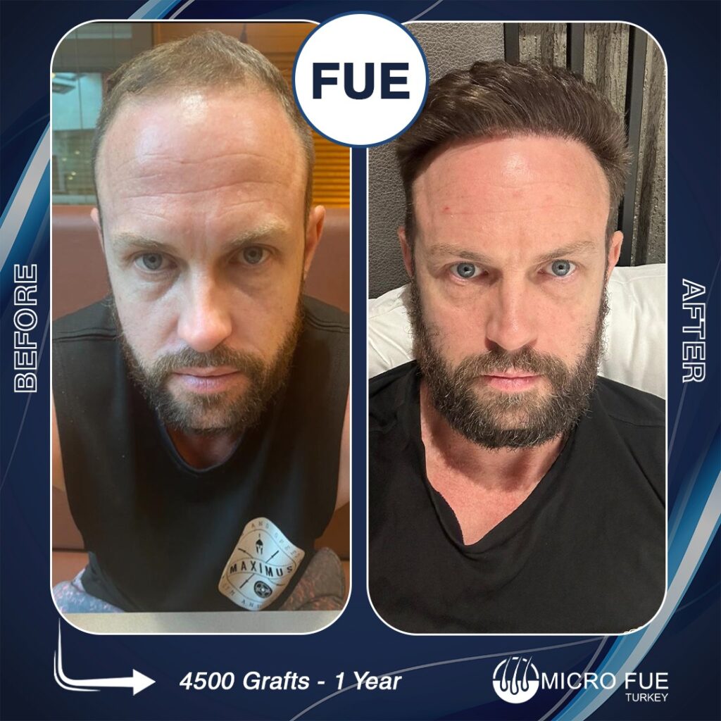 Hair Transplant Techniques in Kuşadası