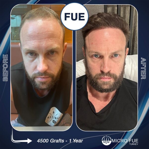 DHI Hair Transplant in Kusadasi DHI Hair Transplant in KusadasiDHI Hair Transplant in Kusadasi