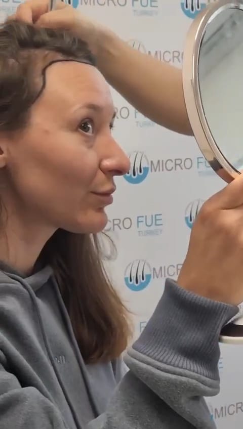 Hair Transplant Techniques in Kuşadası