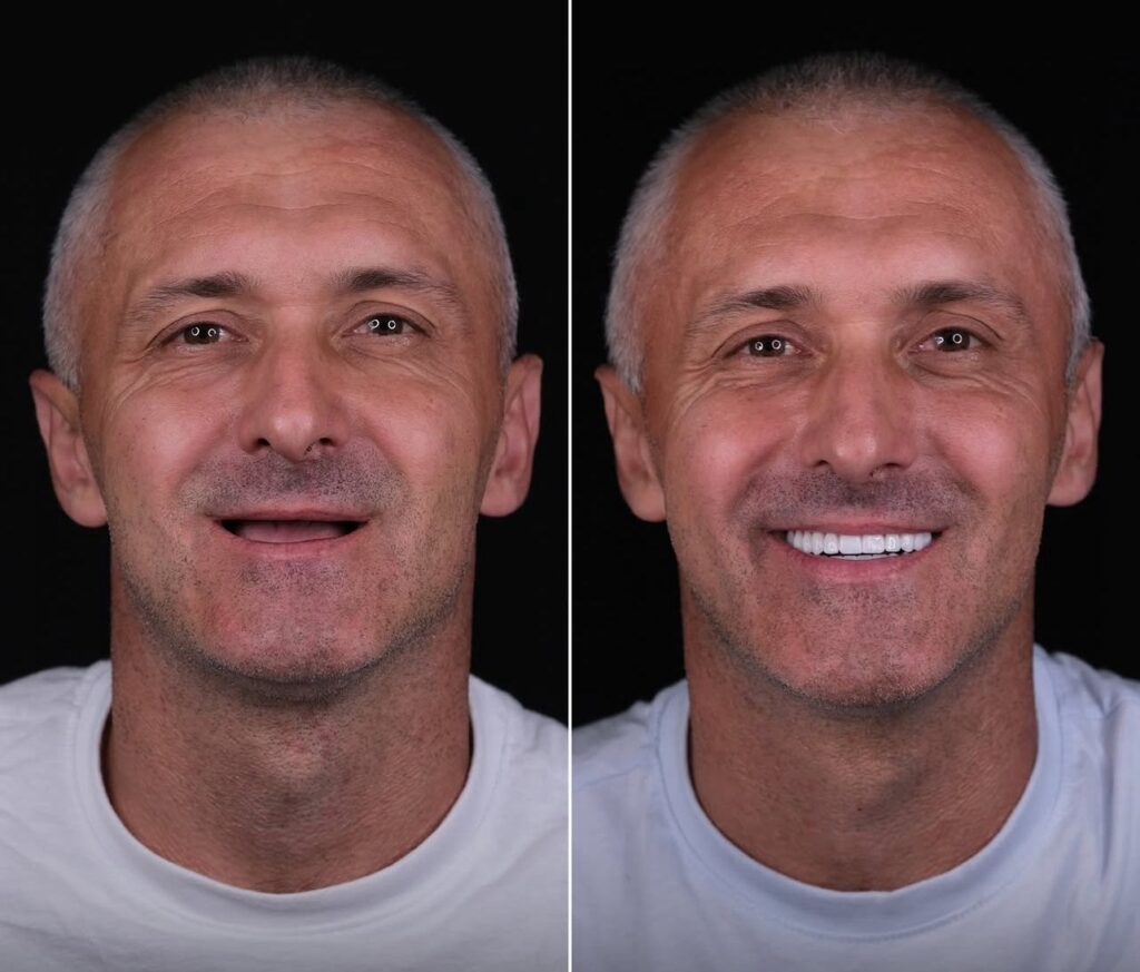 Full Mouth Restoration