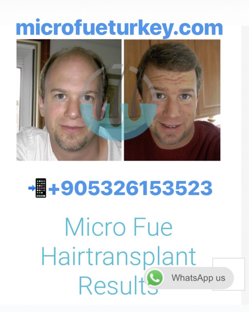 Hair Transplant Techniques in İzmir