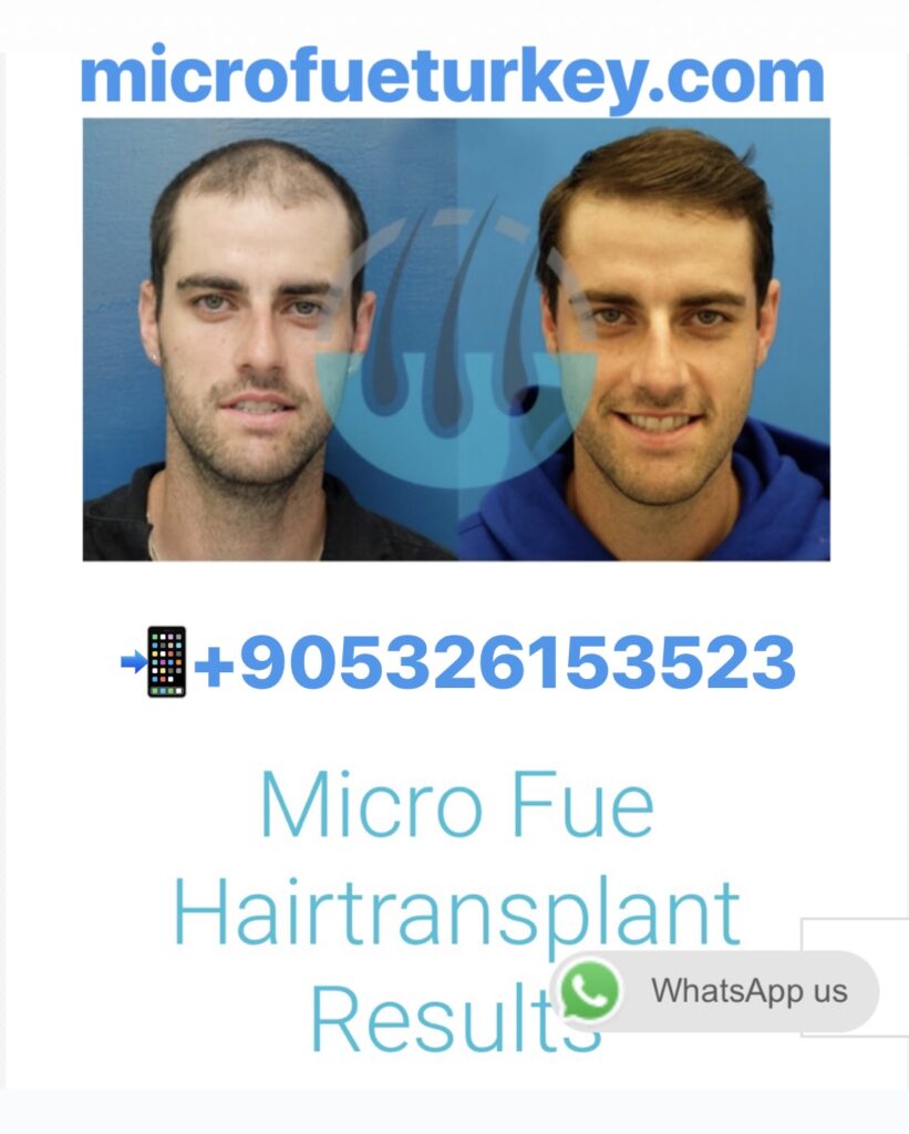 Hair Transplant Techniques in İzmir