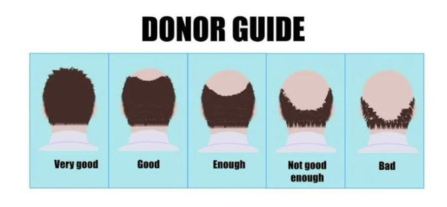 Thin Donor Area Hair Transplant Thin Donor Area Hair Transplant