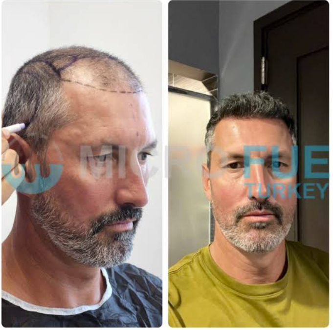 Temple Hair Transplant in Kusadasi Temple Hair Transplant in Kusadasi
